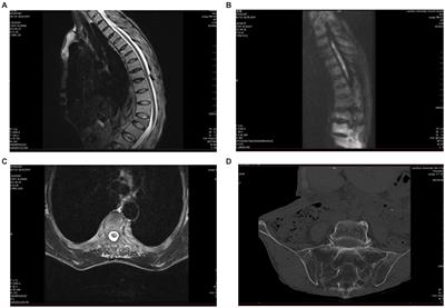 Acute spinal cord infarction secondary to ankylosing spondylitis: a case report and literature review